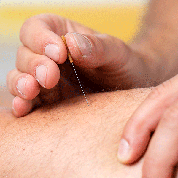 Dry-Needling-Evolution Physiotherapy
