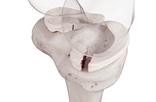 meniscus-operatie-evolution-fysiotherapie