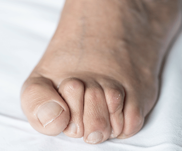 voetklachten-evolution-fysiotherapie
