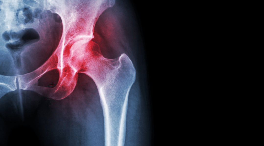 Wat is een snapping hip en hoe kan een fysio hierbij helpen?