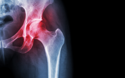 Wat is een snapping hip en hoe kan een fysio hierbij helpen?