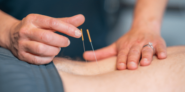 Dry needling Evolution Fysiotherapie