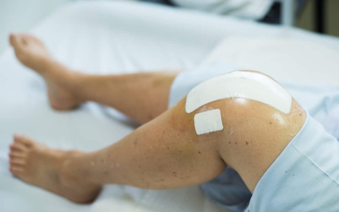 Hoeveel fysiotherapie behandelingen zijn nodig na een knieprotheseoperatie?