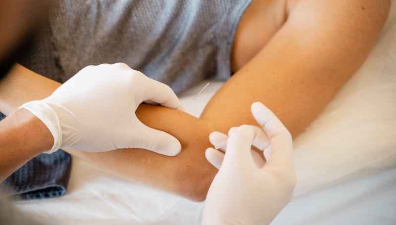 Dry-needling-elleboog