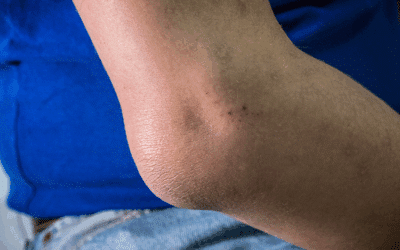 Onze hulp bij klachten door plica synovialis